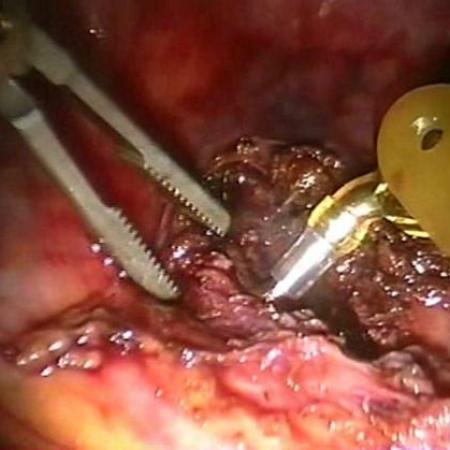 Robotic heller myotomy