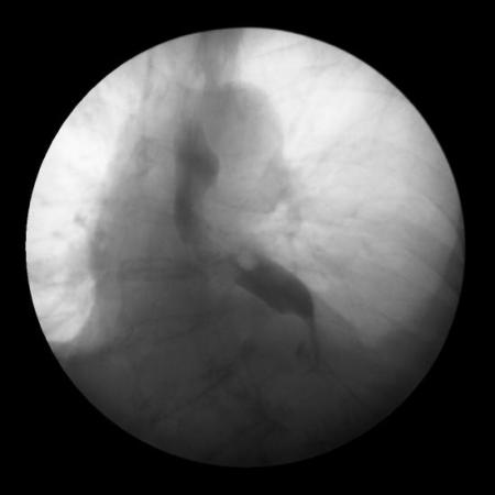 Swallow study after robotic paraesophageal hernia repair