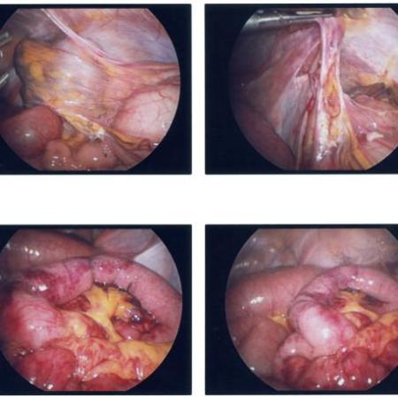 Laparoscopic reduction of internal hernia