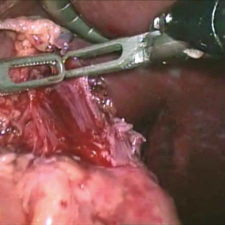 Gentle traction to perform robotic myotomy