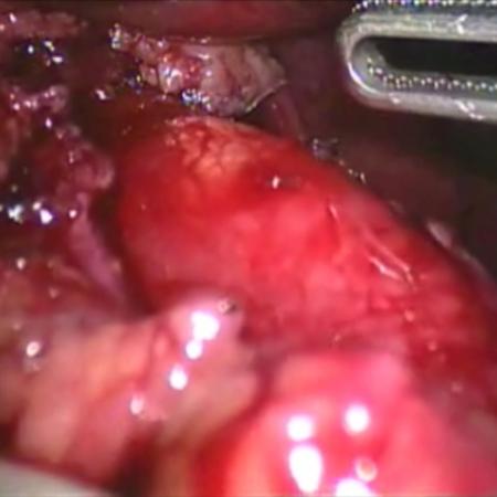 Transillumination of esophageal mucosa after myotomy