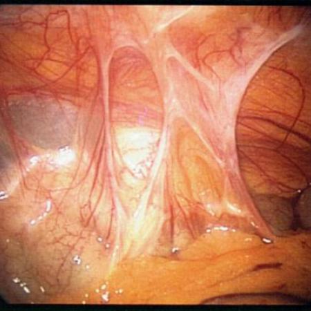 Peritoneal adhesions between large intestine