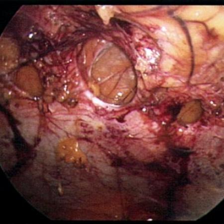 Fascial defects in abdominal wall causing hernias