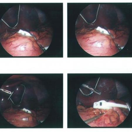 Lap-Band placement for morbid obesity