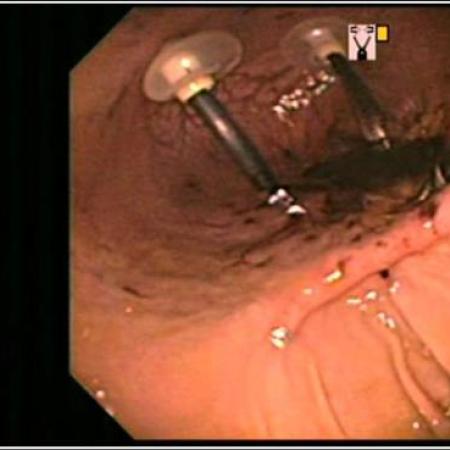 Orientation Difficulties during Intragastric Robotic Surgery