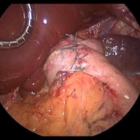 Nissen fundoplication