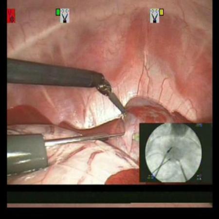 Picture in Picture instead of Overlay for Fluoroscopy