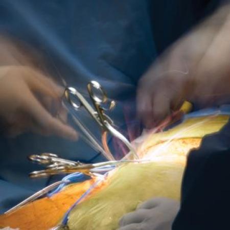 Retractors during open surgery