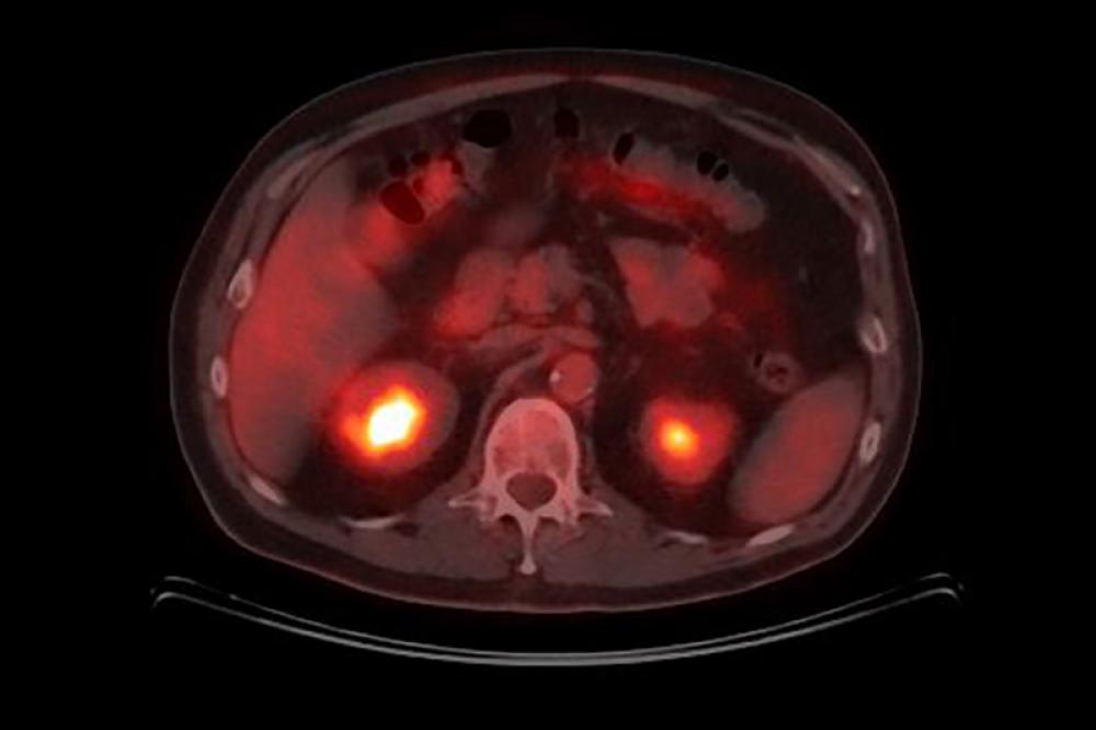 PET Scan para Cáncer