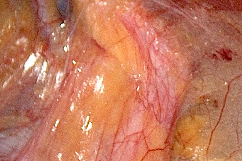 New York Laparoscopic Inguinal Hernia Repair Laparoscopic Md