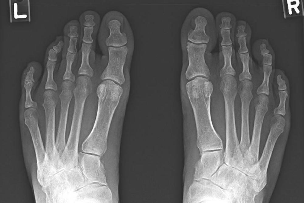Radiografía que muestra osteoartritis de los pies