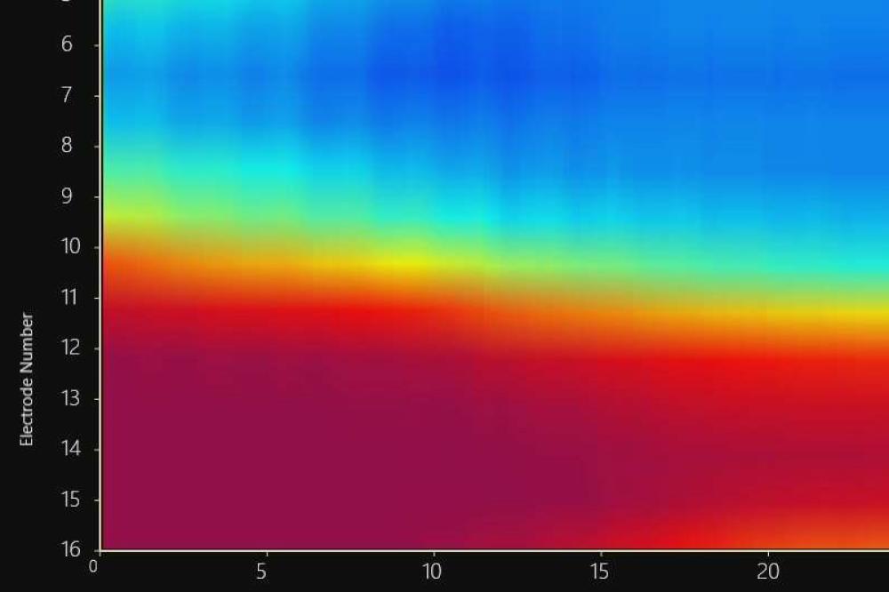 Esophageal Manometry